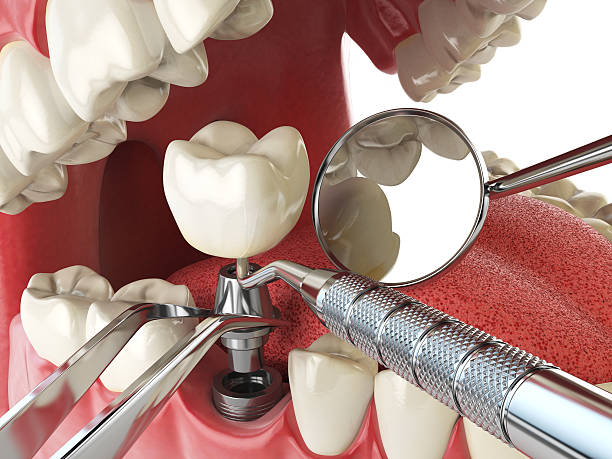 Best Emergency Wisdom Tooth Extraction in Ash Grove, MO